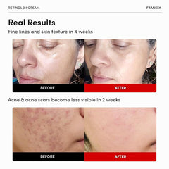 FRANKLY Retinol 0.1% Cream, 1.01 fl oz - Beginner Retinol | Night Cream | with Ceramides